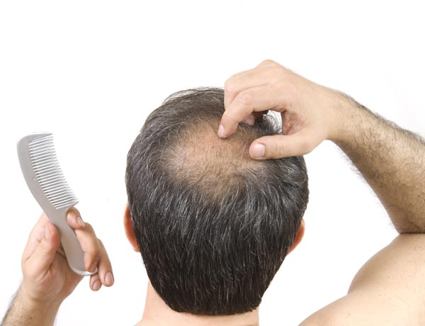  Fue Hair Transplant 