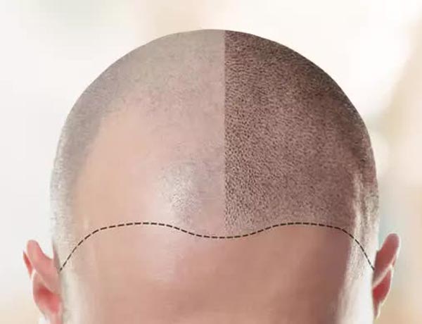  Hair Transplant 
